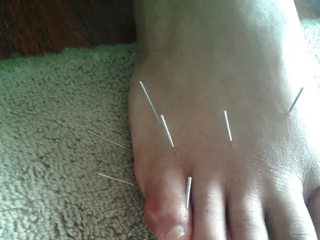 Intervention with endovascular stent grafting proves vital in managing erosion of the superior...